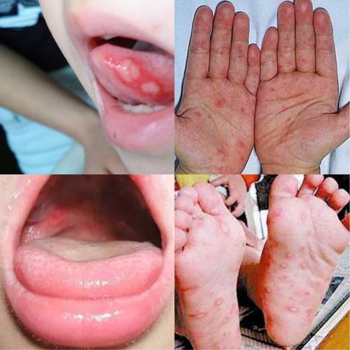 儿童手足口的症状图片