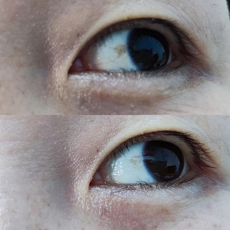 眼睑裂斑初期能彻底治愈吗